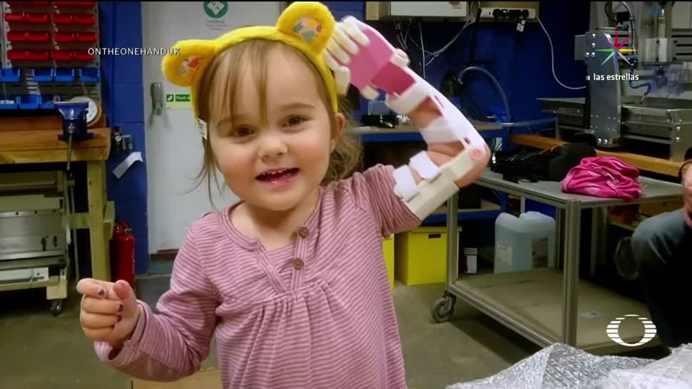Colocan prótesis de mano a niña de 3 años