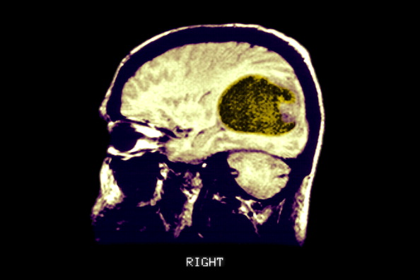 Radiografía de un tumor dentro del cerebro; científicos descubren nuevas causas genéticas del cáncer cerebral (Getty Images, archivo)