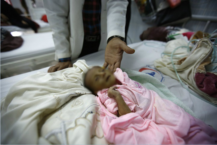 Doctor revisa a un bebé que padece desnutrición en Yemen; el país podría sufrir una crisis de hambruna (AP, archivo)
