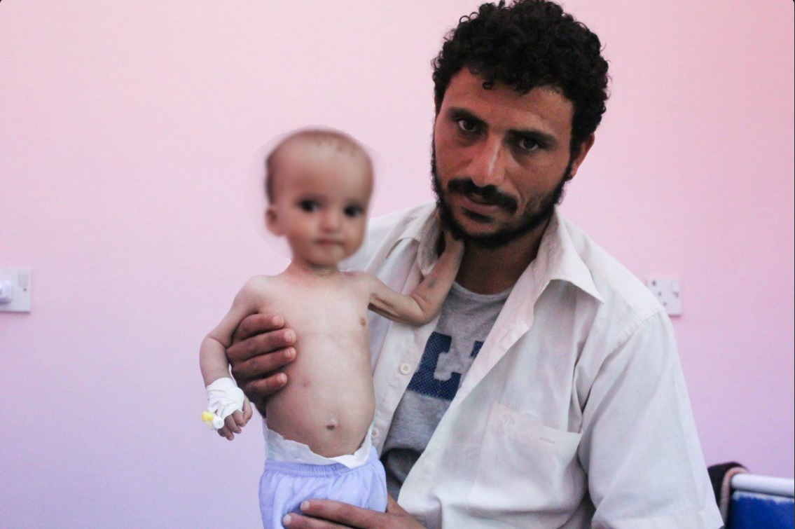 Menor de edad que padece desnutrición en Yemen; el país podría sufrir una crisis de hambruna (Twitter @pulitzercenter)