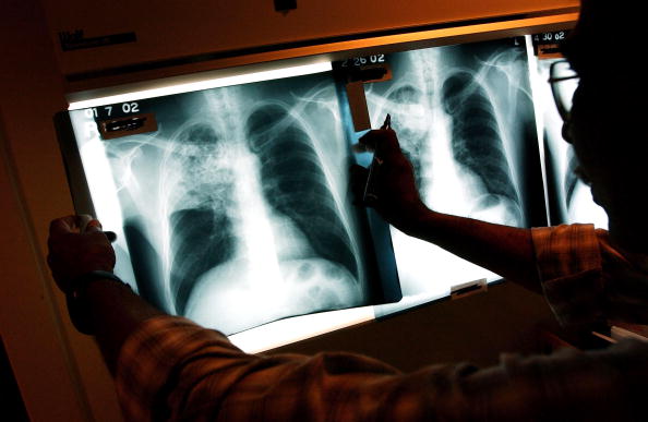 Especialistas examinan una lámina de un paciente infectado con tuberculosis.(Getty Images, archivo)