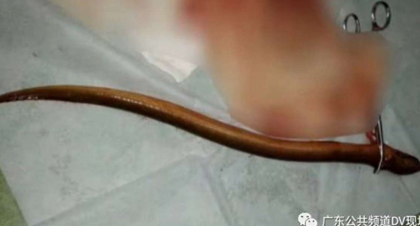  Médicos del sur de China han retirado una anguila viva del estómago de un hombre (Foto: scmp.com)