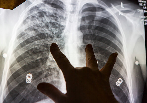 Cada año, se reportan entre 90 y 100 nuevos casos de tuberculosis en Zacatecas. (Getty Images, archivo)