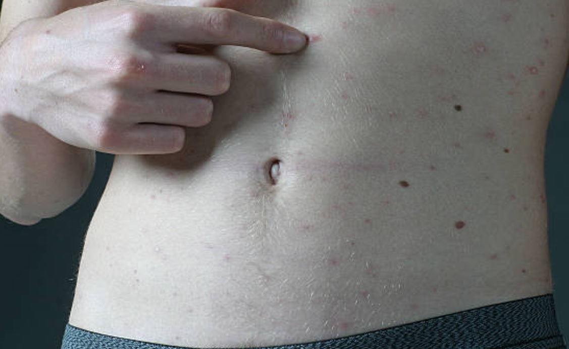 La varicela es altamente contagiosa para las personas que no padecieron la enfermedad o no se vacunaron. (Getty Images/Archivo)