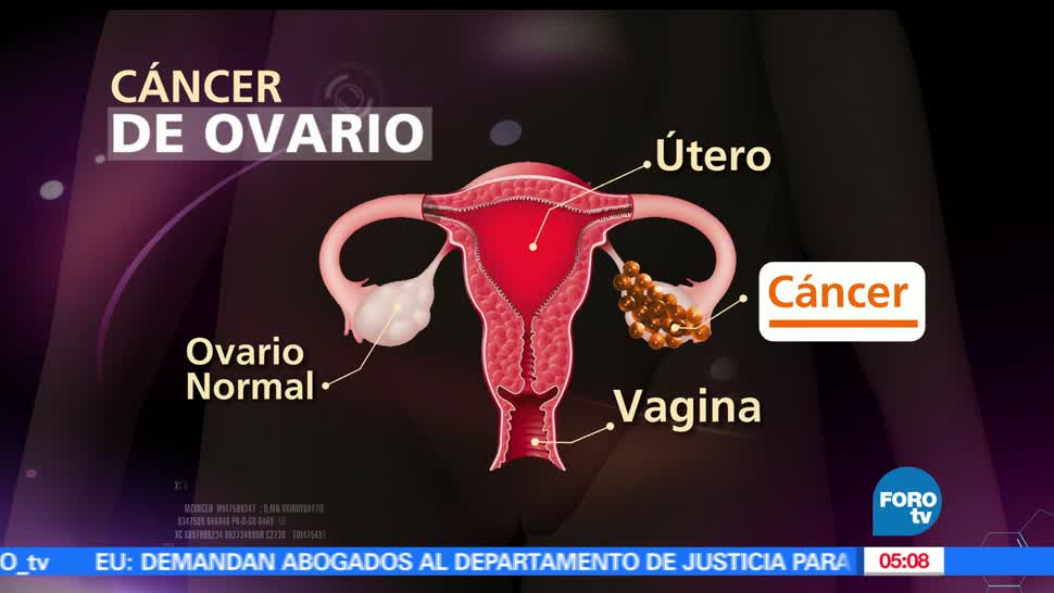 lunes, Día Mundial del Cáncer de Ovario, letales, mujeres