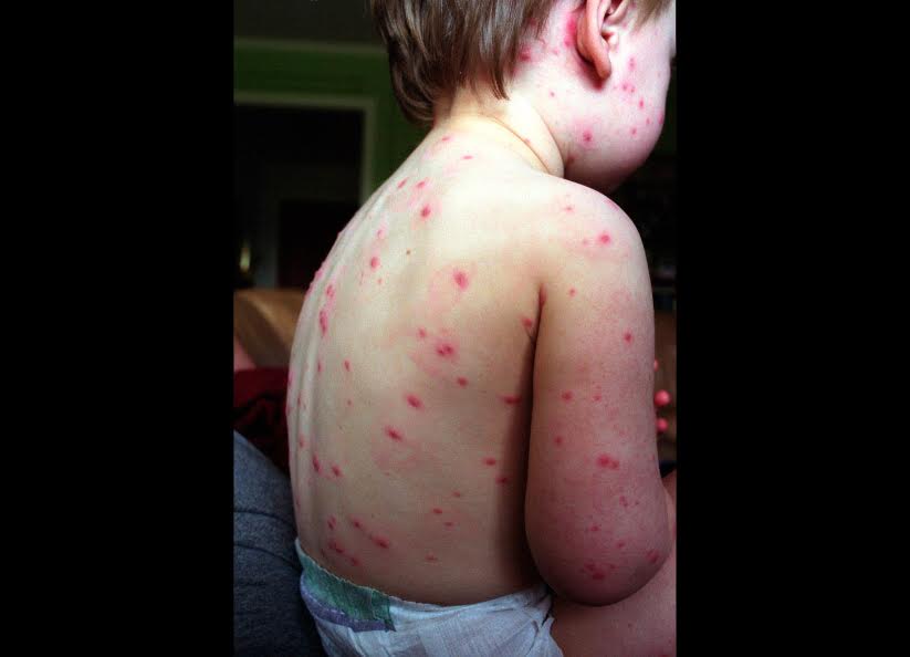 Se registran más de 2 mil casos de varicela en las ocho regiones del estado. (Getty Images, archivo)