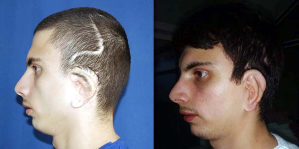 La primera operación en el mundo de implante de orejas a un hombre que nació sin ellas (Foto: (Foto: newsturk))