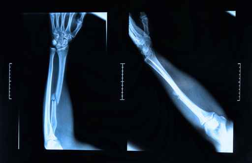 Radiografía, rayos x, huesos, fractura, niños de cristal, salud