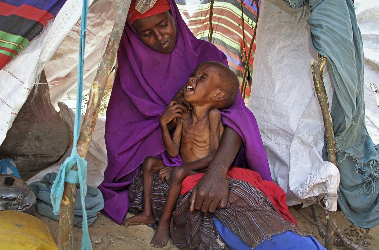 Una madre consuela a su niño desnutrido, Ibrahim Ali, de 7 años (AP)