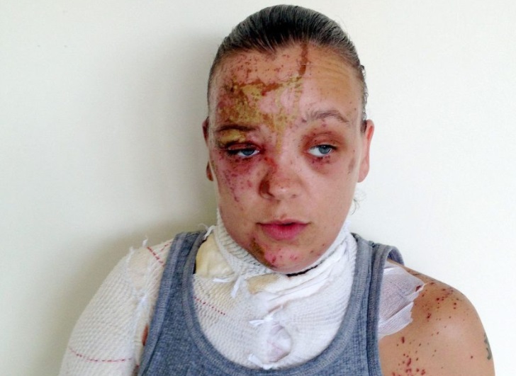 Taraq Quigley fue atacada con ácido en la cara en Londres (The Sun)