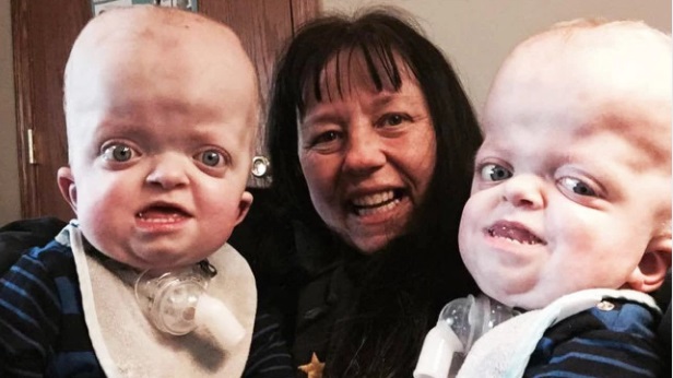 Enfermera adopta a unos gemelos con una deformidad genética en el cráneo