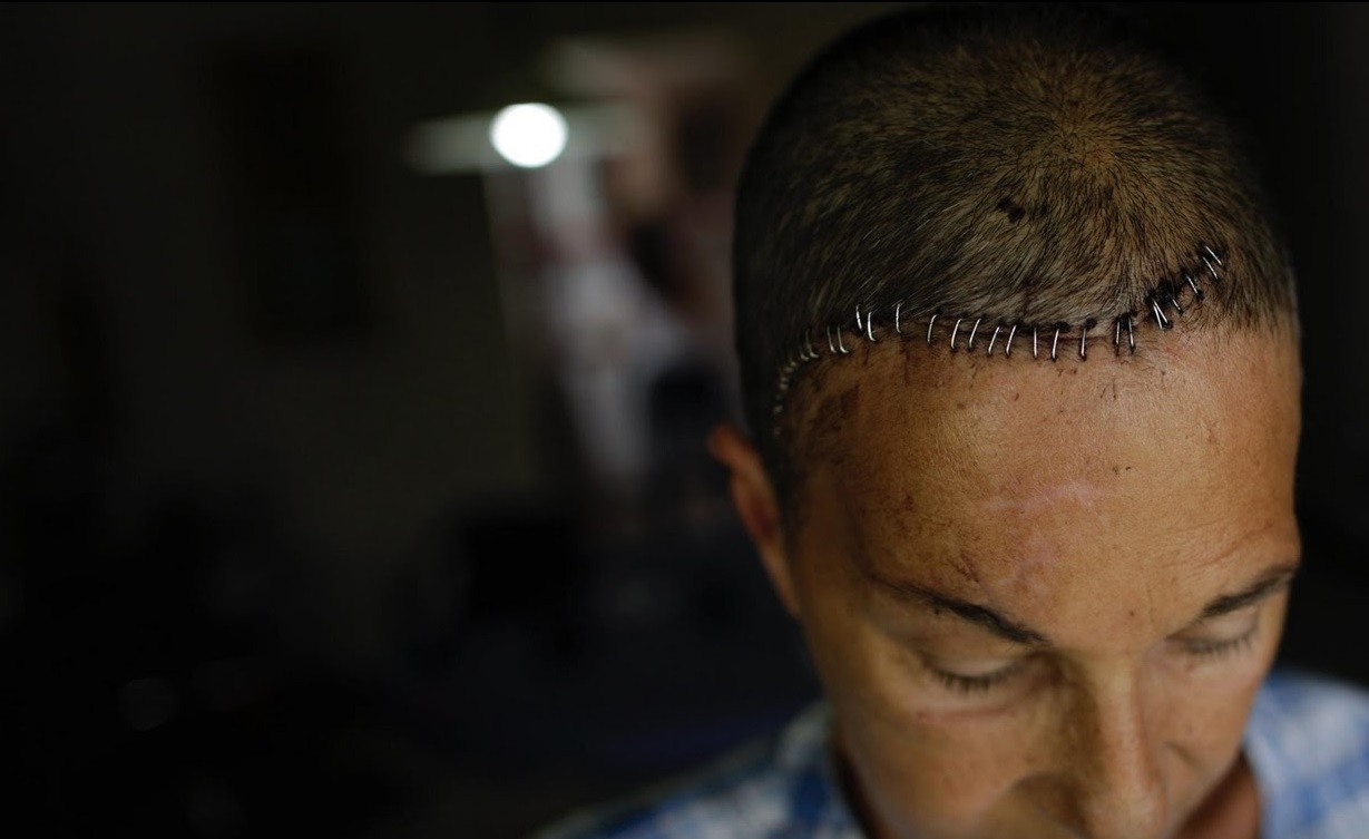 heridos en protestas en Venezuela intentan recuperarse