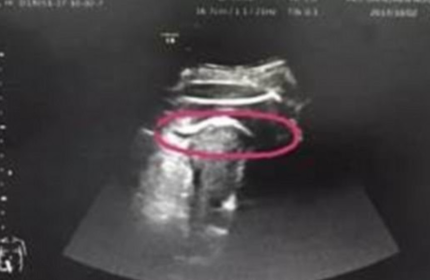 Un bebé en China rompe el útero de su madre con patadas
