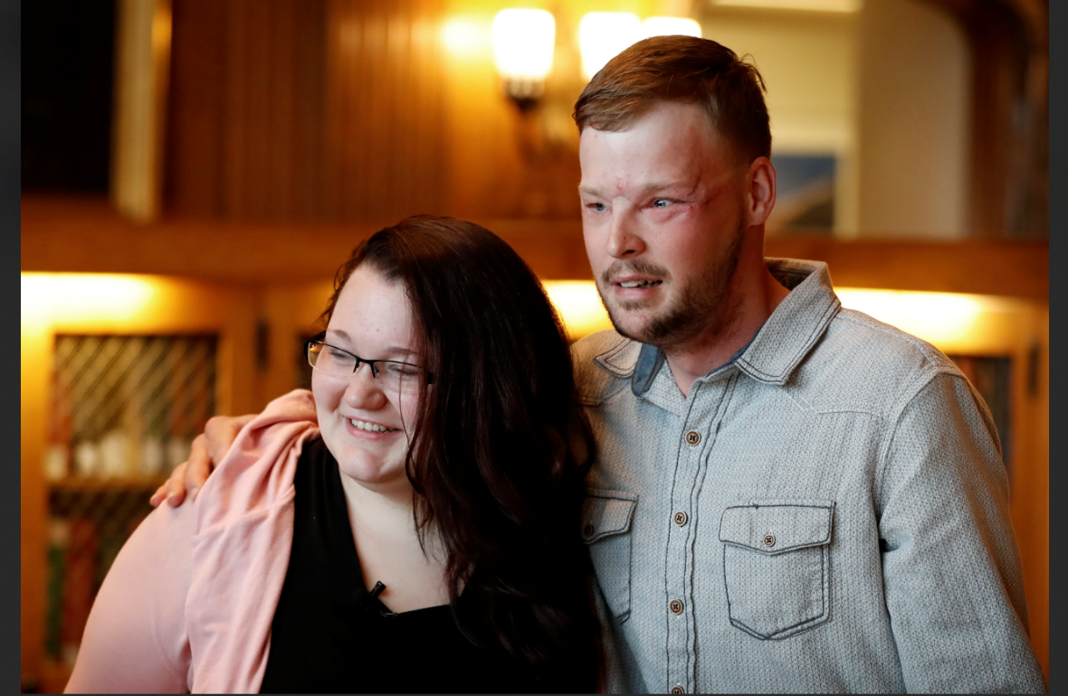 Lilly y Andy se conocieron 16 meses después del trasplante de rostro al que fue sometido él