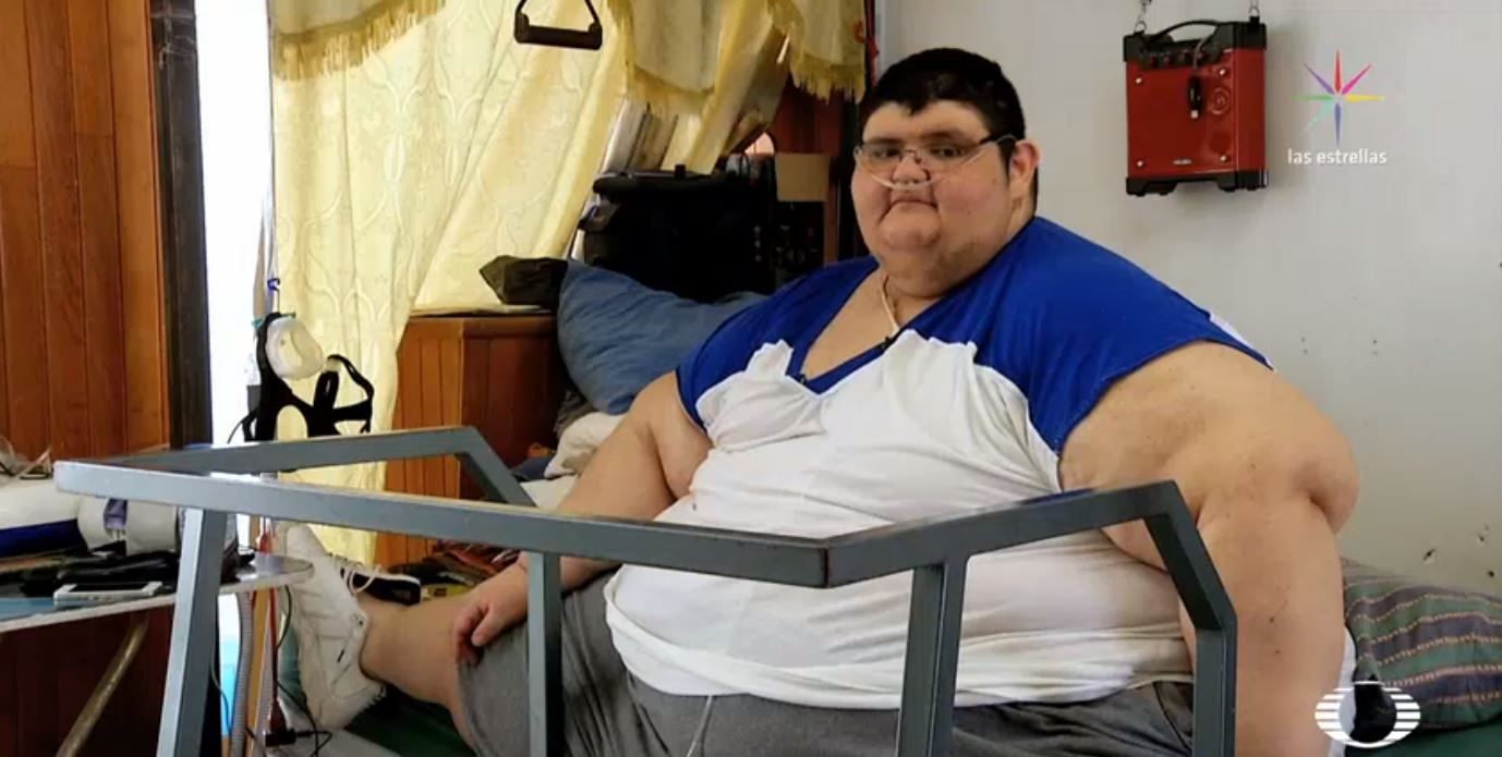 Juan Pedro, considerado el hombre más obeso del mundo, pierde más de 230 kilos debido a una cirugía de manga gástrica que recibió en Guadalajara.