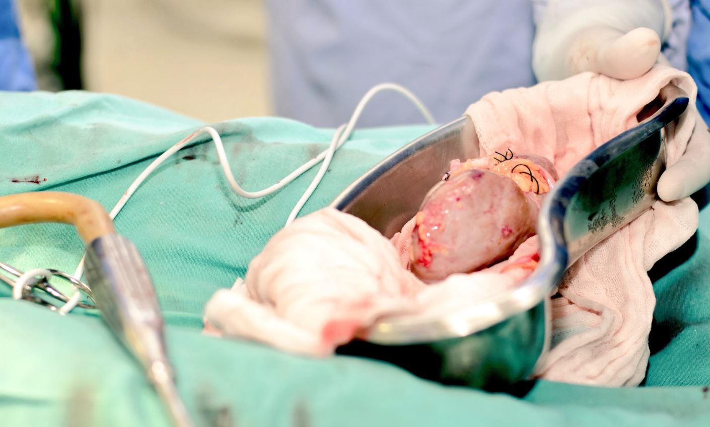 Hospital Juárez de México realiza primer trasplante renal cruzado múltiple