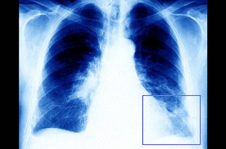 La tromboembolia pulmonar es considerada la tercera causa de muerte cardiovascular en el mundo. (Archivo/Gettyimages)