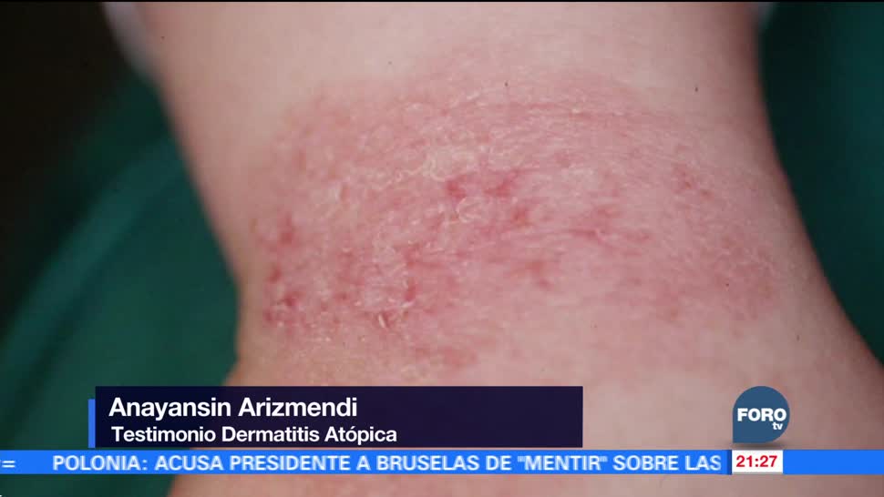 Aumentan casos de dermatitis atópica por frío