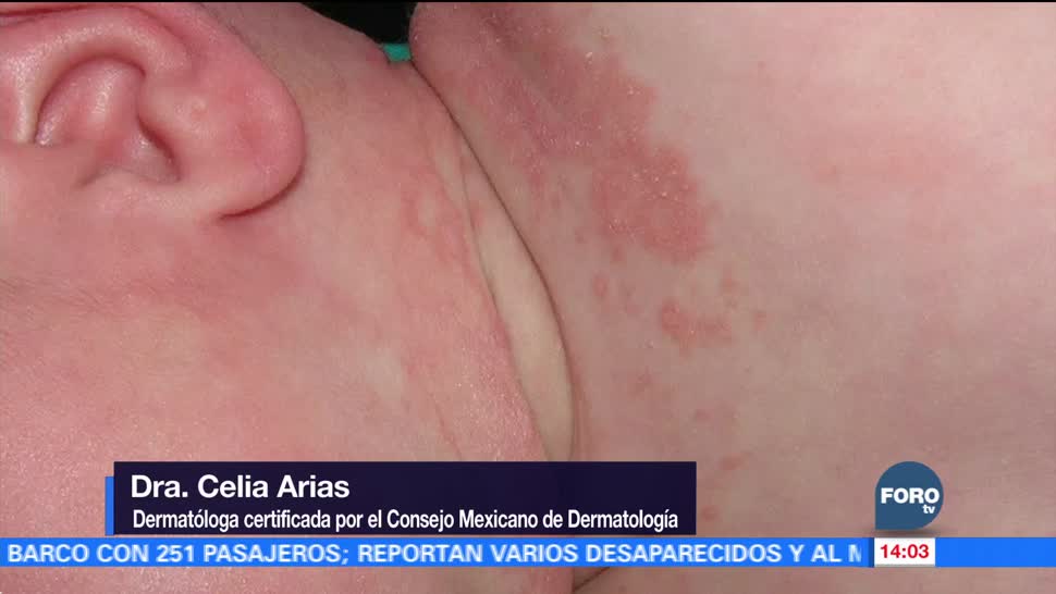 El frío provoca aumento en casos de dermatitis atópica