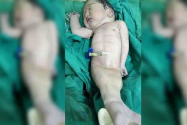 Nacimiento de una bebé ‘sirena’ sorprende a médicos en la India