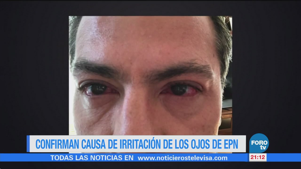 Confirman causa de irritación de los ojos de EPN