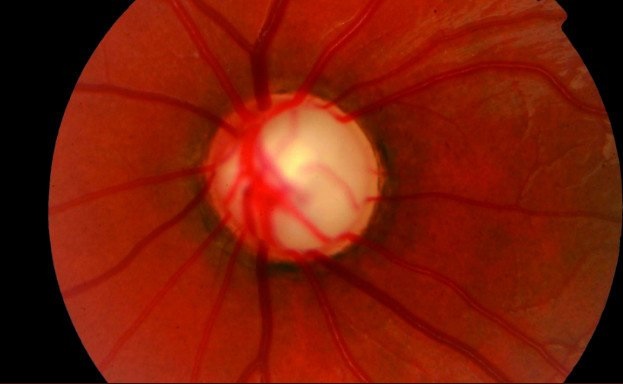 conozca los síntomas del glaucoma
