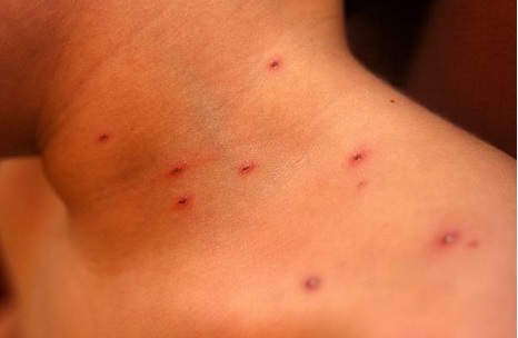 Aumentan casos de varicela durante temporada de calor en Yucatán