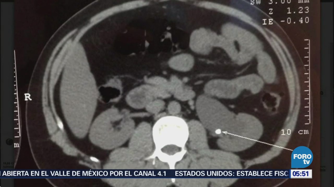 Cálculos renales, tercera patología urológica en México
