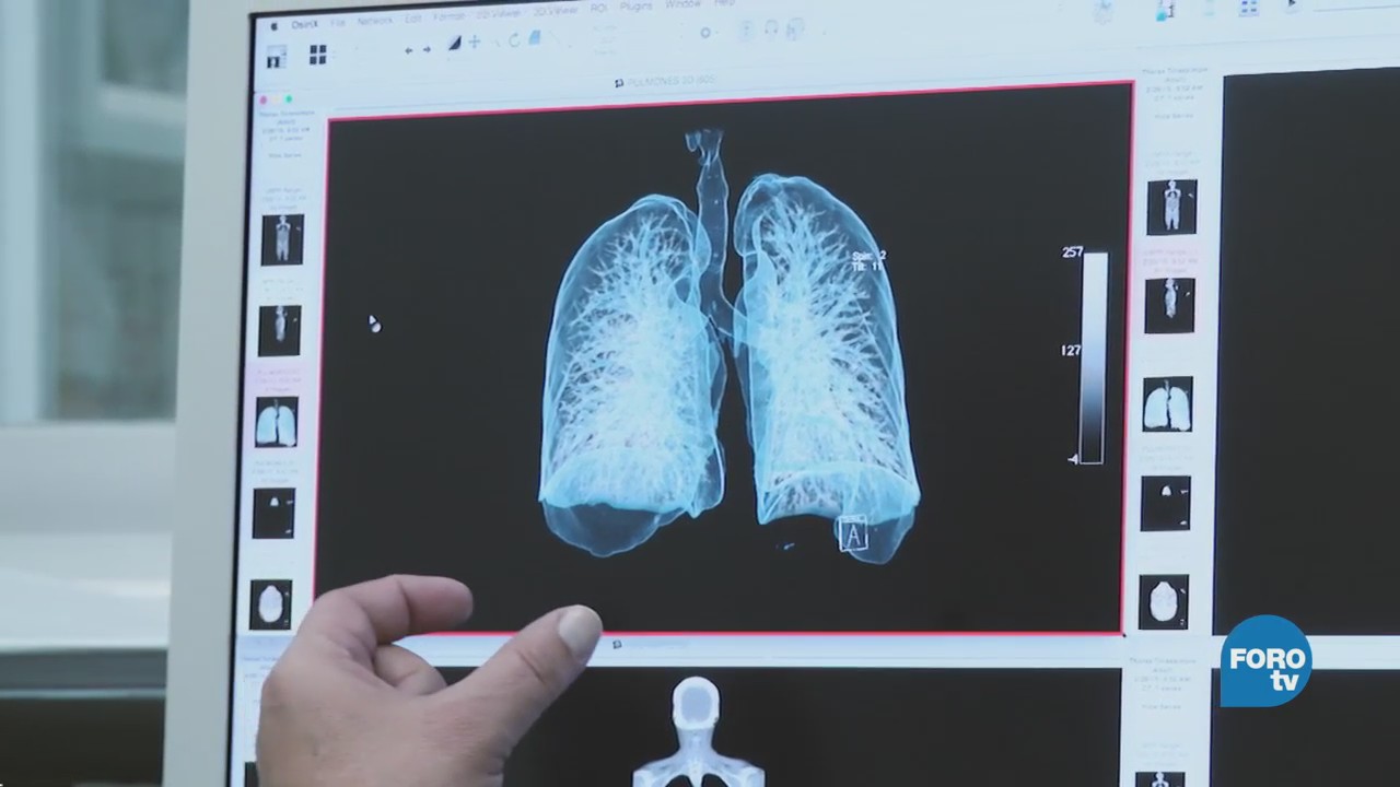 ¿Cómo se obtiene una tomografía?
