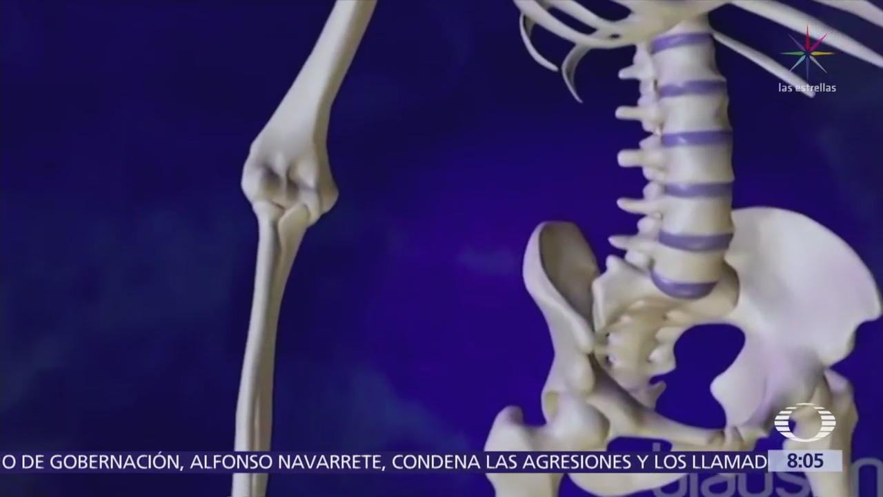 Osteoporosis es más frecuente en habitantes del centro y sur de México