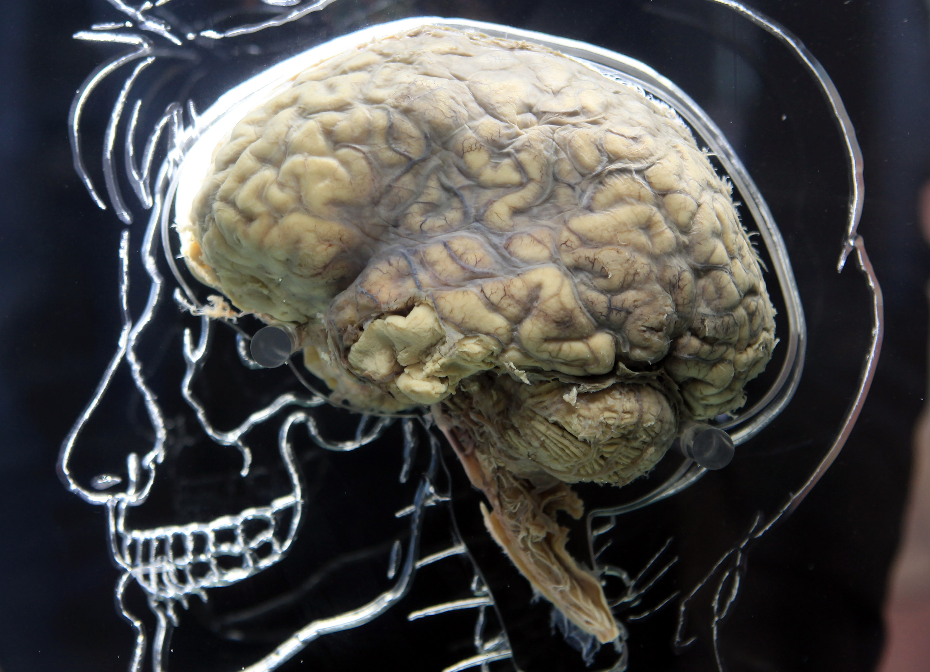 Estos factores envejecen el cerebro y reducen su tamaño