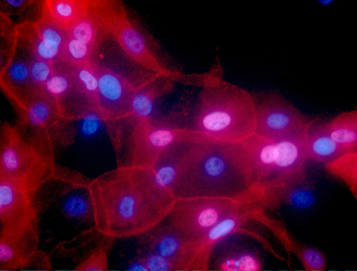 Nanorobots Tumores Cancerígenos Cáncer Ratones Melanomas