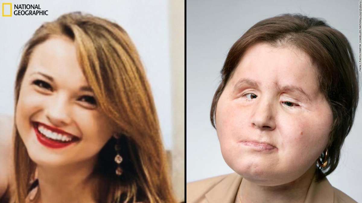 National Geographic documenta el impresionante trasplante de cara de Katie Stubblefield