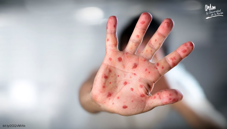 Casos de sarampión en Europa pueden impactar en México