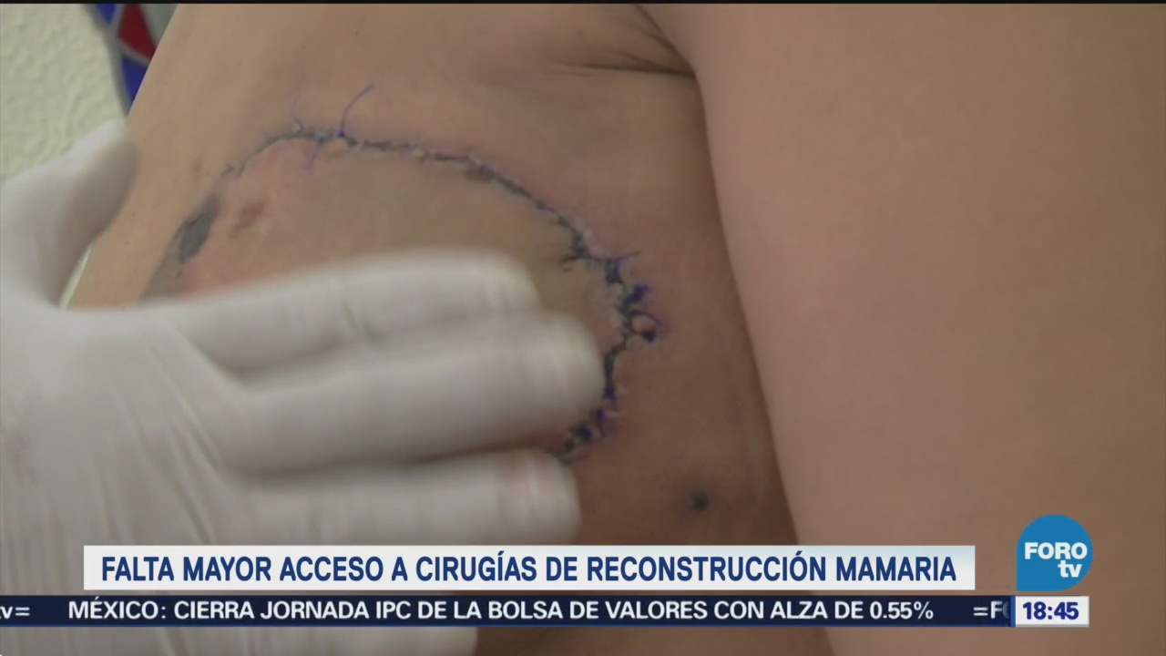 Falta Acceso Cirugía Reconstrucción Mamaria Extirpación Seno