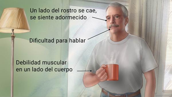 Conoce los principales síntomas de un ACV, mediante el HaBraSo: Habla, Brazos, Sonrisa (Claves De Salud)