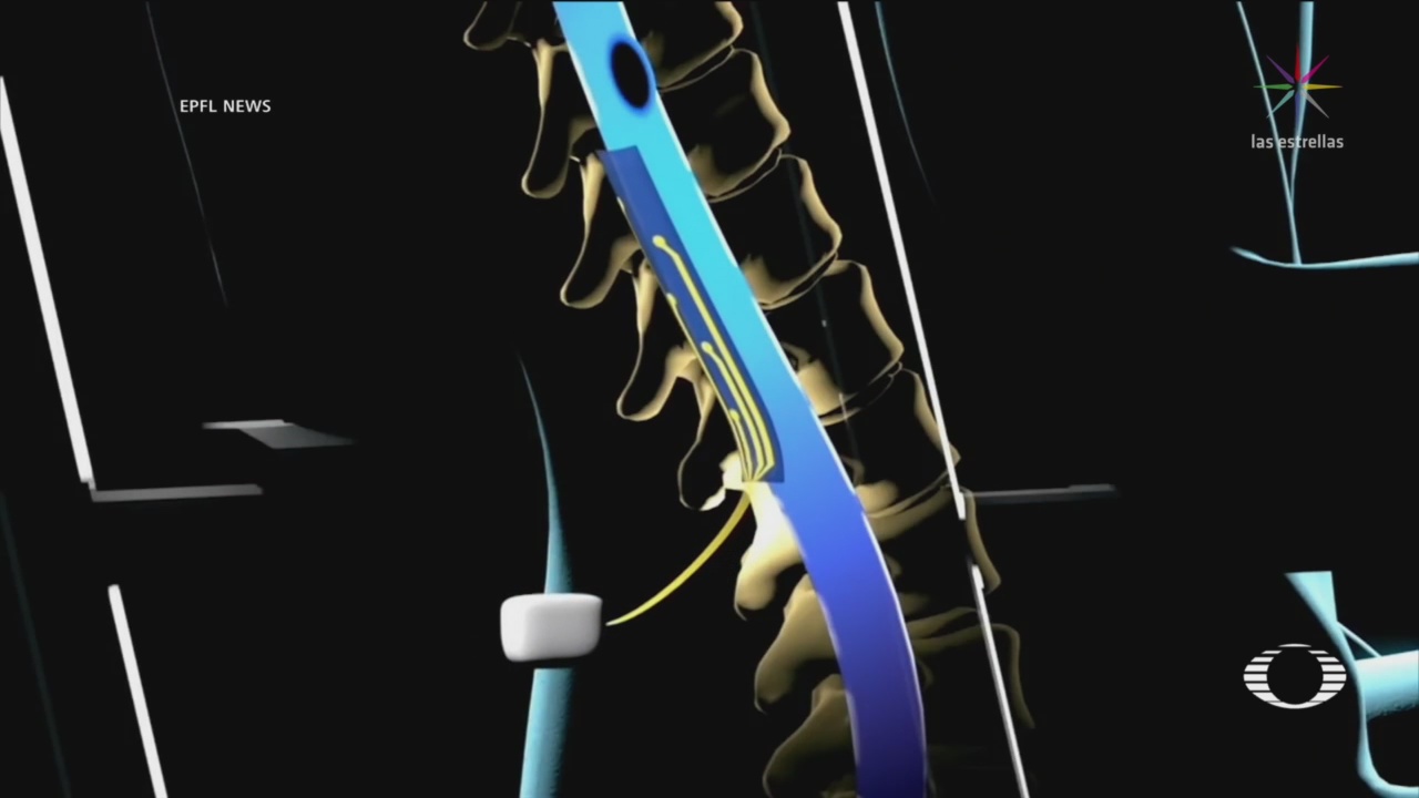 Estimulación Eléctrica Esperanza Lesión Médula Espinal
