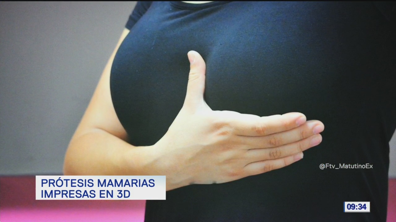 Imprimen prótesis mamarias en 3D