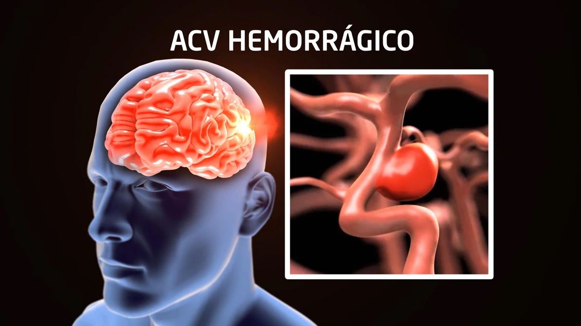 Un ACV hemorrágico se produce cuando un vaso se debilita y se rompe, provocando hemorrágea en el cerebro (Infobae)