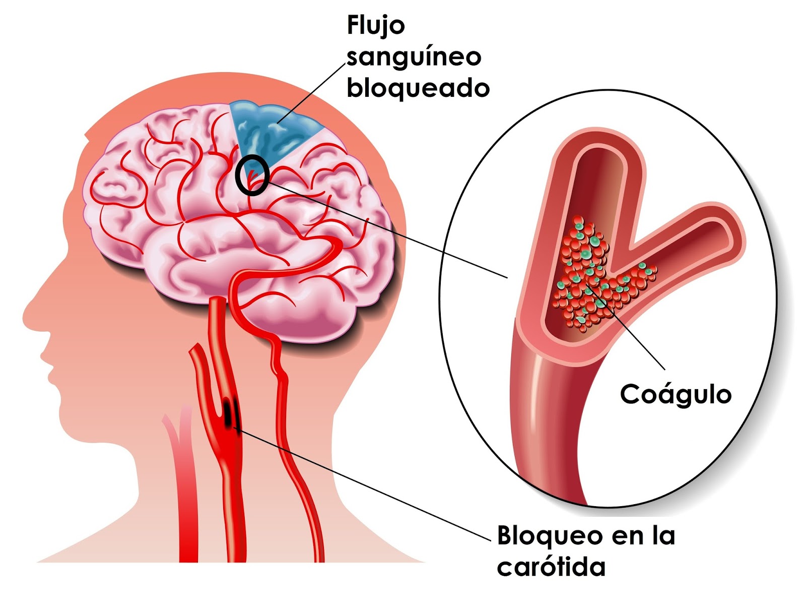 Un ACV isquémico es el más frecuente y se produce cuando un coágulo de sangre bloquea un vaso sanguíneo en el cerebro (Claves De Salud)