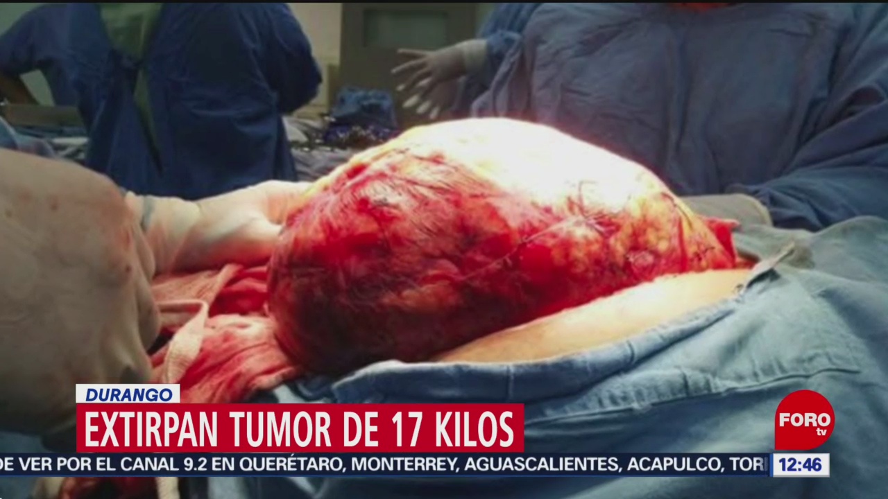 Extirpan tumor de 17 kilos en Durango