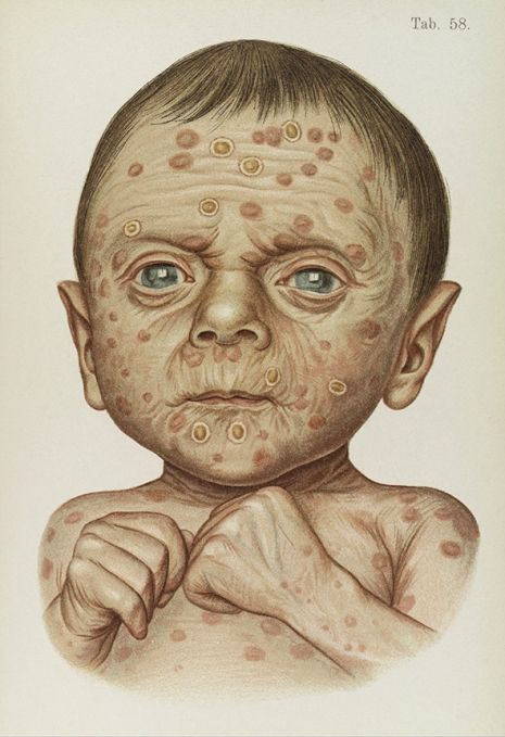 Dibujo del siglo XIX que muestra a niño con sífilis hereditaria (Artsy)