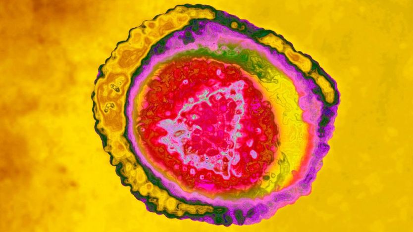 El virus del herpes zóster infecta cualquier tipo de células nerviosas (en la imagen) y puede causar daños sostenidos en el cerebro conforme aumenta la edad (GettyImages)