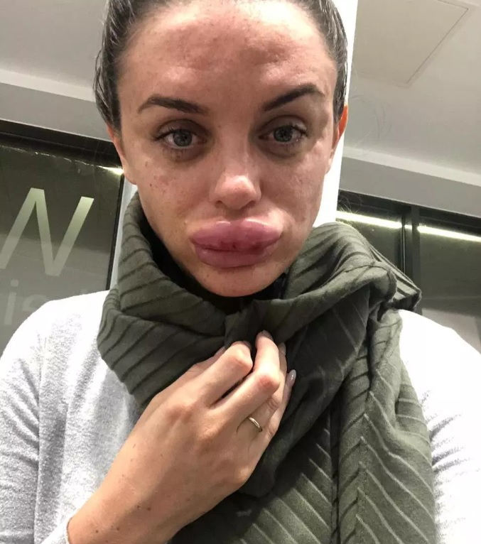 Mujer asiste a 'fiesta de bótox' y termina traumatizada en el hospital por la hinchazón de sus labios