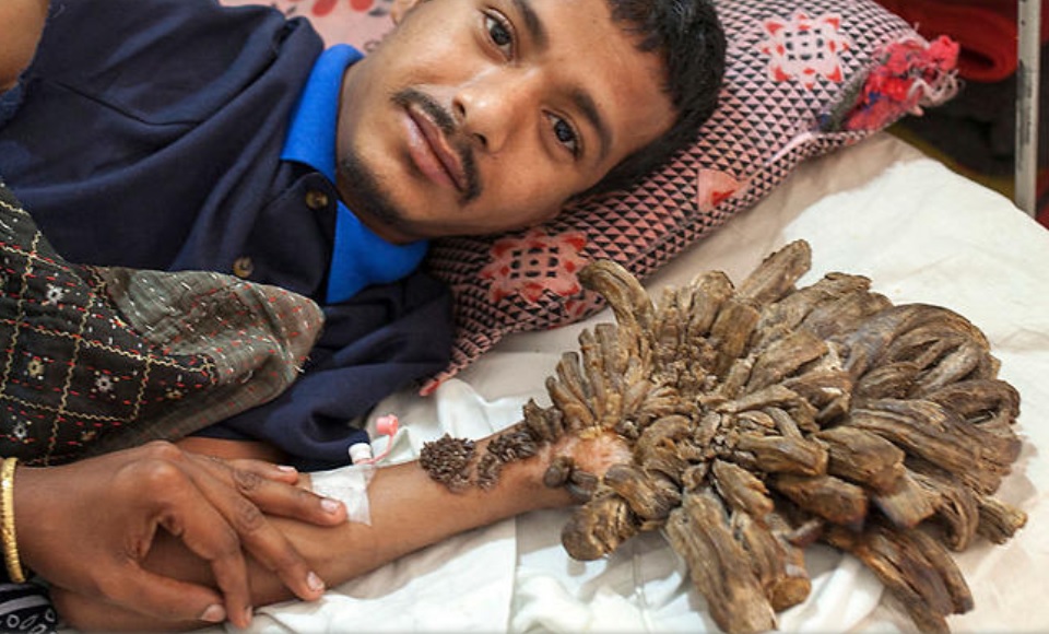 El ‘Hombre árbol’ de Bangladesh recae y necesita nuevas cirugías