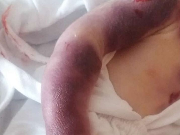 Muere recién nacido por quemaduras de incubadora improvisada en Bolivia