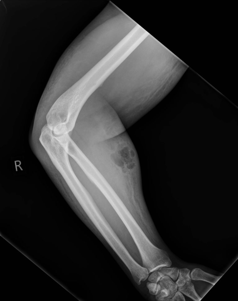 Una radiografía también muestra el daño que el hombre se hizo al fallar múltiples veces en la inyección de líquido seminal en un brazo (Irish Medical Journal)