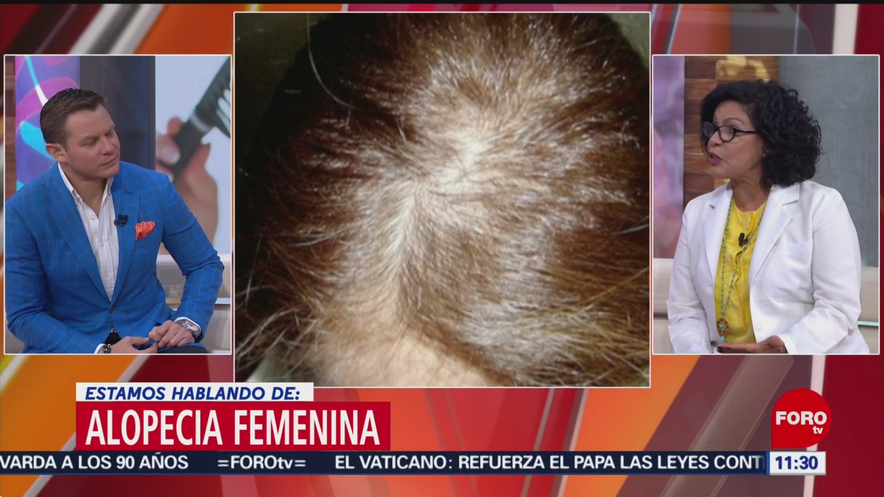 Foto: Prevenir Alopecia Femenina Cuidados 29 de Marzo 2019
