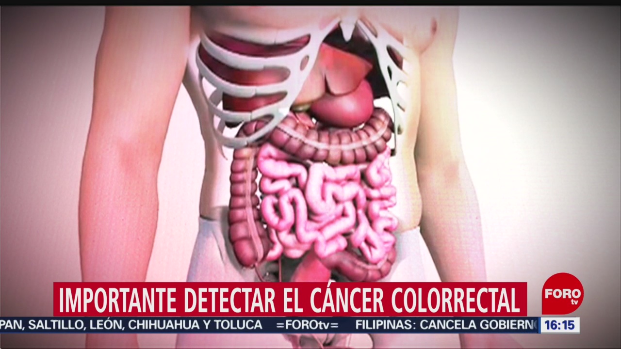 Foto: Diagnóstico de cáncer de colon puede tardar años