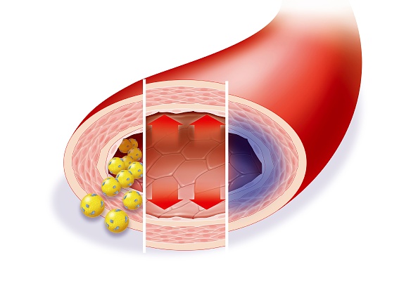 La formación de placa en las arterias a causa del colesterol alto es una de las causas de raíz de las enfermedades cardiovasculares (Getty Images)